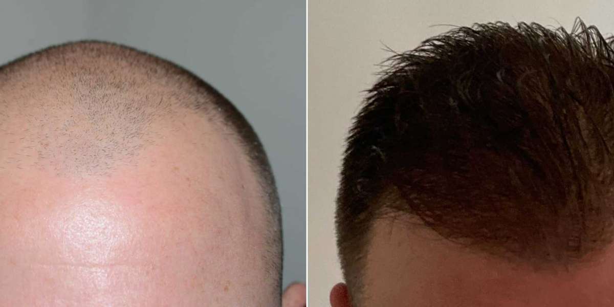 African American hair transplant before after