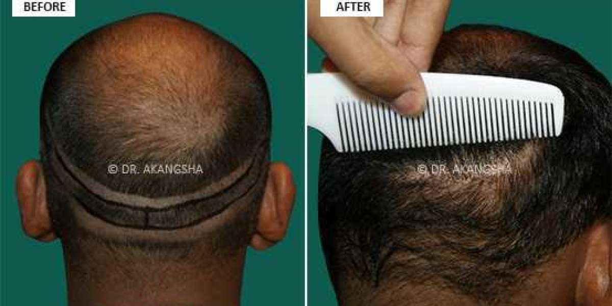 Planning For Hair Transplant-Things That You Must Know