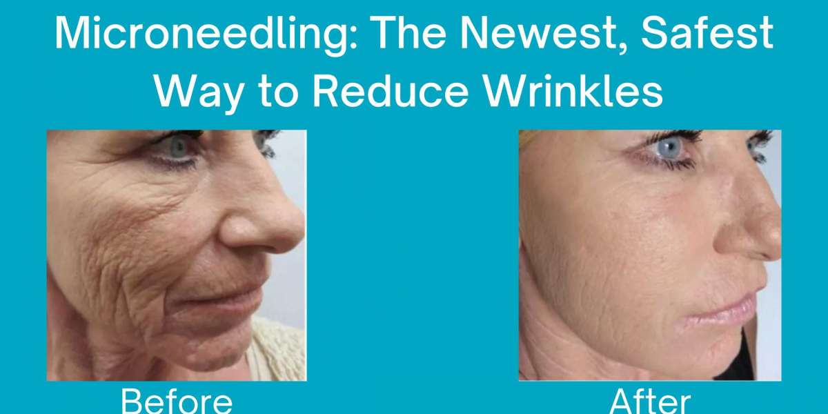 Microneedling: The Newest, Safest Way to Reduce Wrinkles