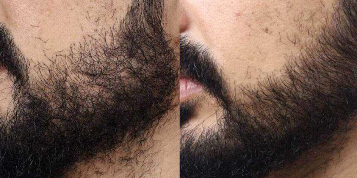 Emplante De Barba