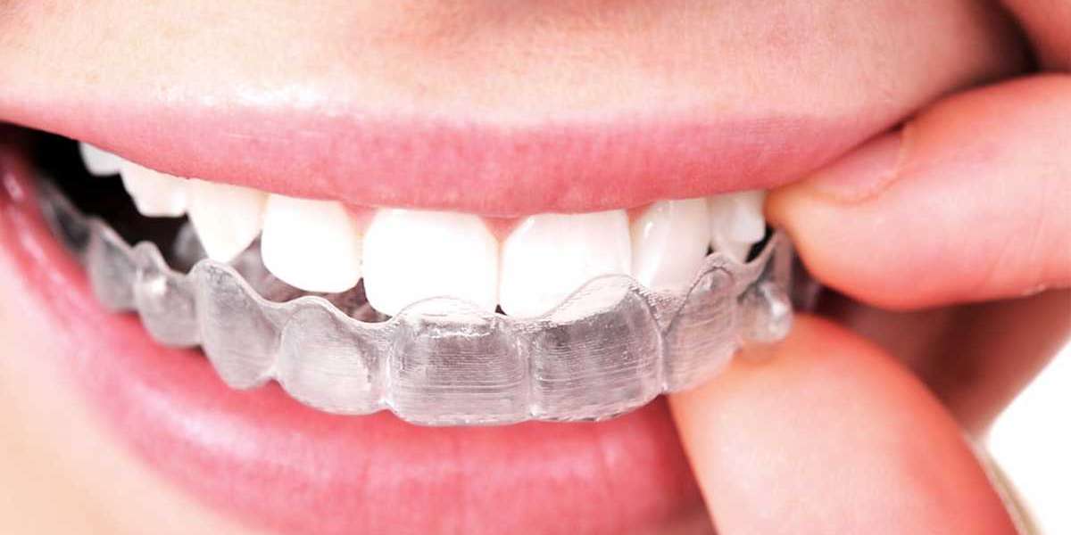 The Orthodontic Innovation: Unveiling the Wonders of Invisalign Treatment