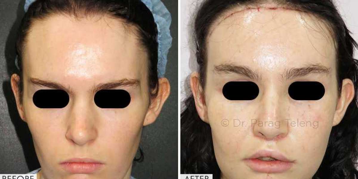 Facial Feminization Surgery in USA, UK & India