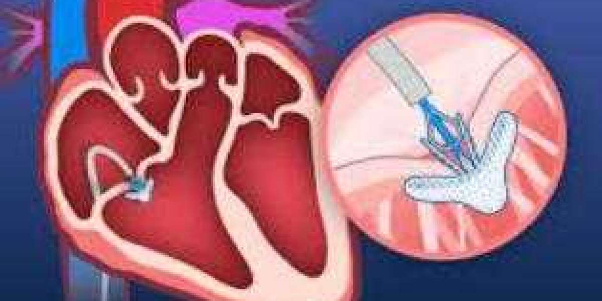 Transcatheter Tricuspid Valve Intervention: A Growing Market for Innovative Heart Valve Treatment