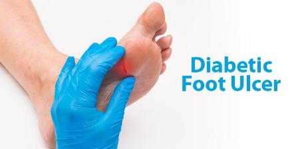 Global Diabetic Foot Ulcers Market to Reach US$ 9,300.6 Million by 2030: Trends, Growth Drivers, and Key Players