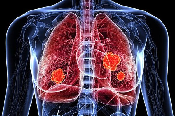[Giải Đáp] Ung thư phổi có dùng được sâm không?