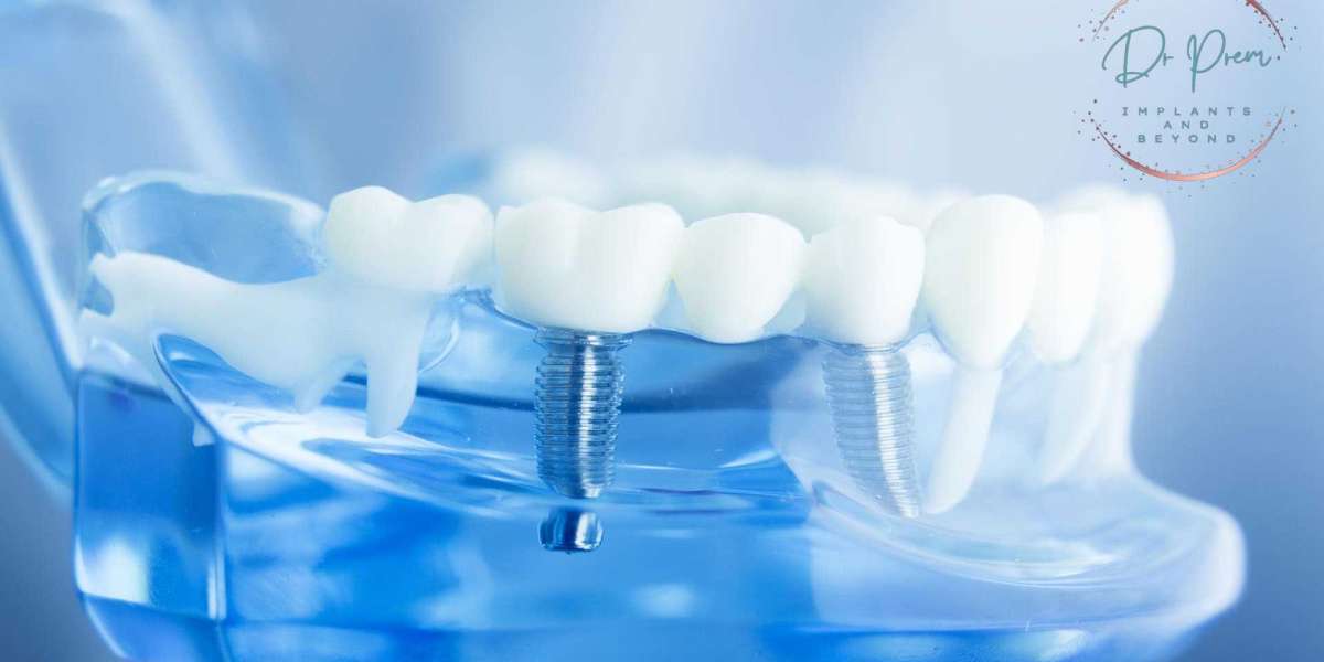 Full Mouth Restoration: Choosing Between All-on-6 and Dental Implants (doctorprem)