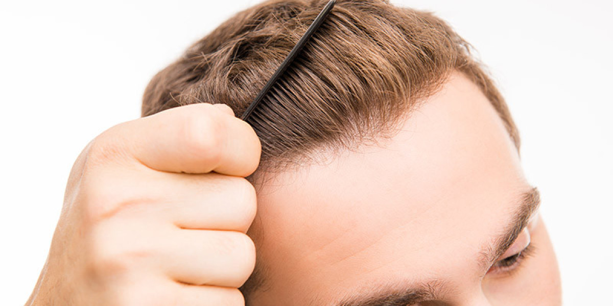 7 Ways In Which Men And Women Can Prevent Hair Loss