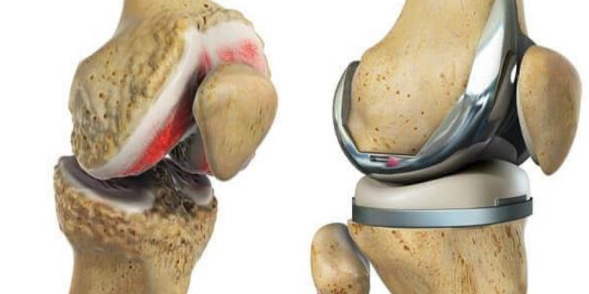 Knee Replacement Market Size, Sales, Forecast & Analysis 2032
