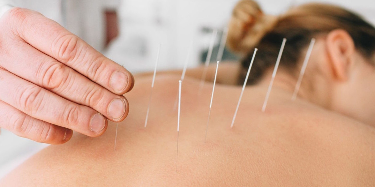 Mind and Body Harmony: Discovering the Healing Touch of Acupuncture Nearby