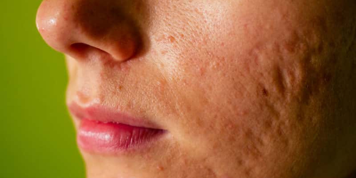 Transform Your Skin: Acne Scar Treatments in Dubai