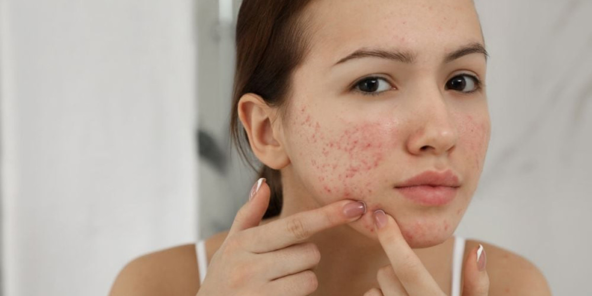 Dubai's Skincare Revolution: Modern Approaches to Acne Treatment