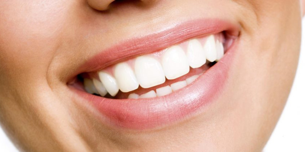 Achieving Radiant Smiles: The Ultimate Guide to Teeth Whitening in Los Angeles