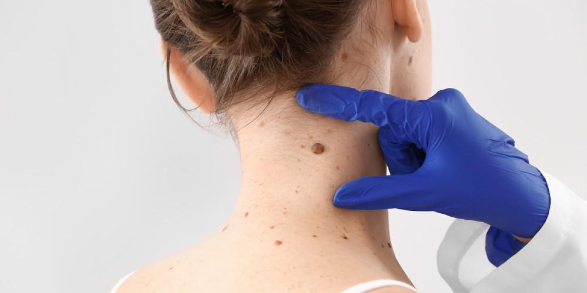 Dubai Dermatology: Cutting-Edge Skin Tag Removal Techniques