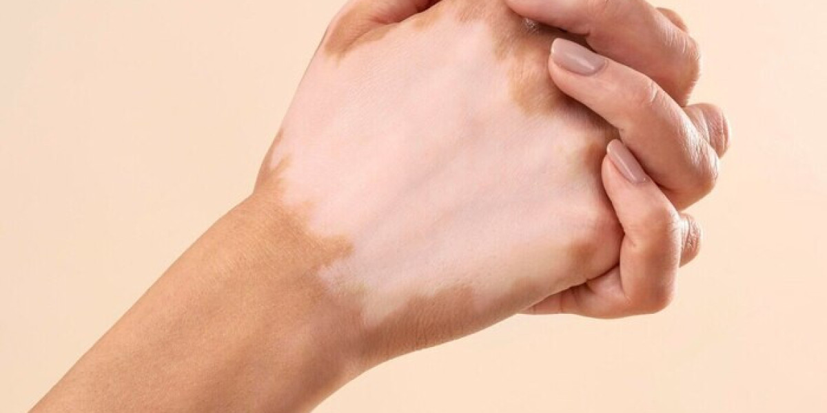 Unlocking Confidence: Excimer Laser Treatment for Vitiligo in Dubai