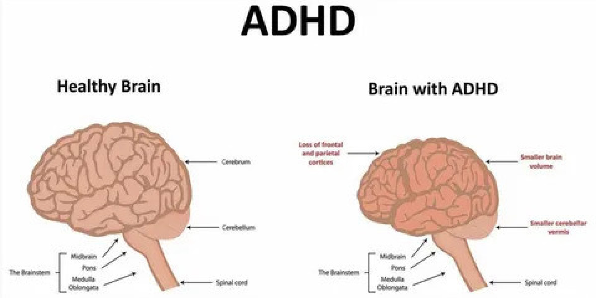 Investigating Mindfulness-Based Stress Reduction as a Treatment for ADHD
