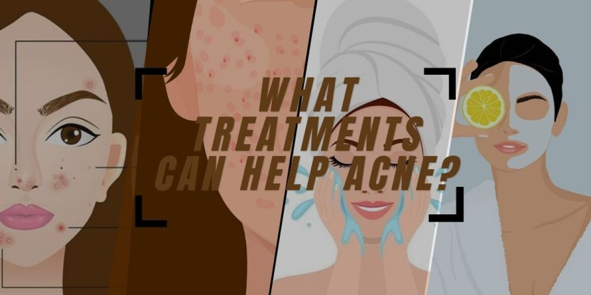 What treatments can help acne?