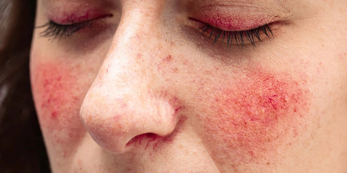 Rosacea Treatment Market, Share, Size, Demand and Forecast 2024-2032