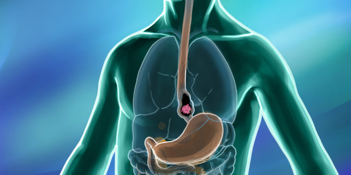 Esophageal Cancer Market Size 2024: Epidemiology, Industry Trends and Forecast by 2034